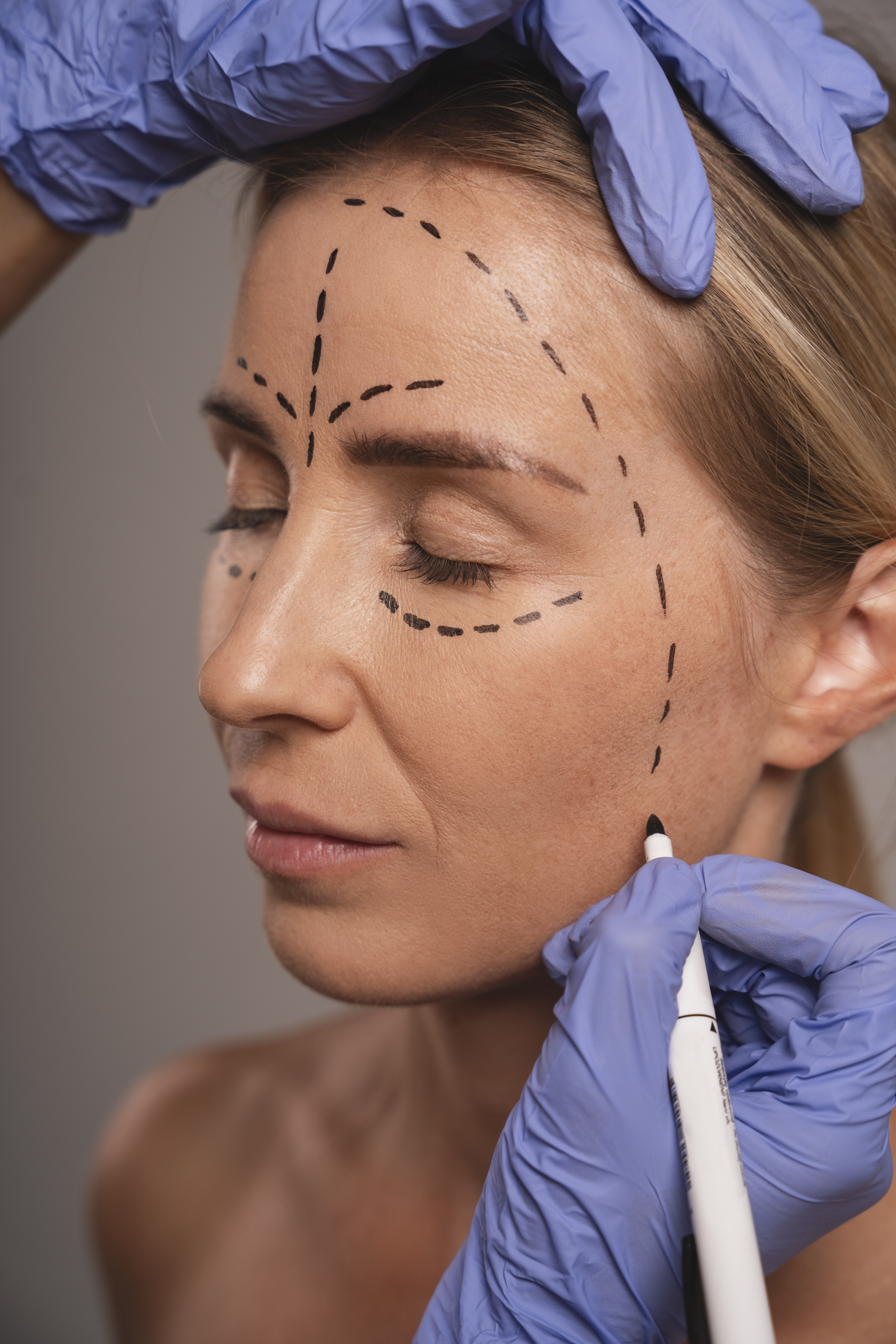 Gesichtsmarkierungen vor einem Facelift – präzise Planung für eine harmonische Verjüngung.
